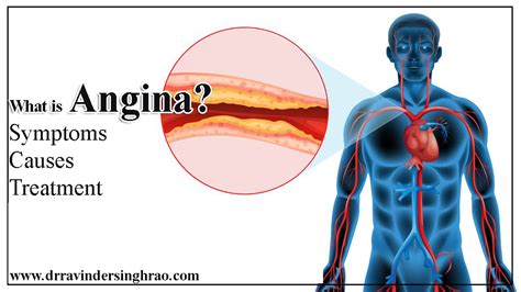 strutainis angina.